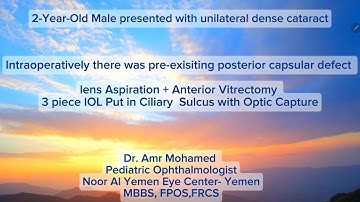 Pediatric cataract surgery with sulcus IOL with Optic capture