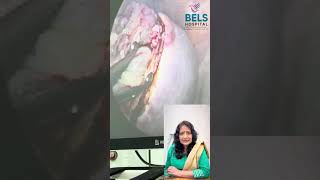Laparoscopic Surgery for Degenerated 8-9cm Submucous Fibroid Uterus