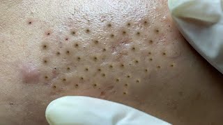 Satisfying video with Hien Nguyen Spa Beauty #024