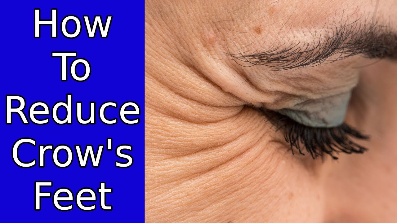home remedies for crow's feet around eyes