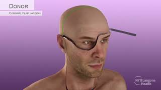 Aaron James's PartialFace & TotalEye Transplant Surgical Animation, 2023