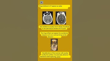 Ring artifact #CTScan #shorts