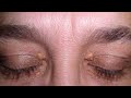 आंखो के कोलेस्ट्रॉल से छुटकारा || Xanthelasma||Eye Cholesterol Home Remedies||Eye Cholesterol remove