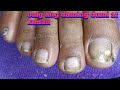 Big Ingrown toenail relief, Satisfying removal