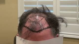 Class 5 Advanced Hair Loss Pattern Restoration With Hair Transplant Dr. Diep www.mhtaclinic.com