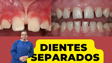 ¿Por qué se me separan los dientes frontales inferiores?