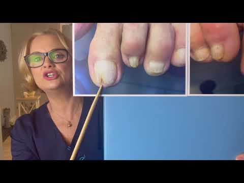 Wideo: Jak wygląda grzybica paznokci?