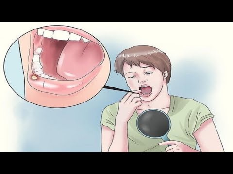 Video: Cum să vindeci o tăietură pe limba ta: 14 pași (cu imagini)
