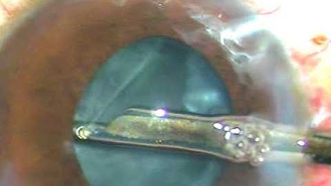 Keep adrenalin, keep Iris Hooks in OT to help you complete surgery nicely