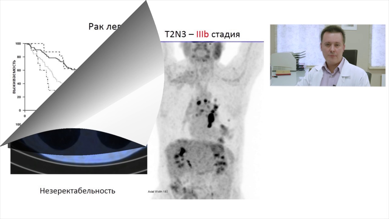 ПЭТ/КТ в диагностике рака легкого