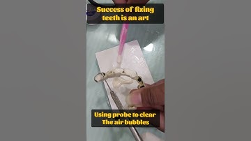 How to fix a bridge on Basal Implants? Dr. Praveen Bhatia #basalimplants #dental #teeth