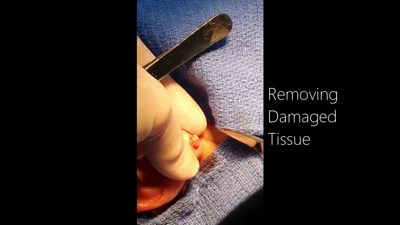 Earlobe Repair