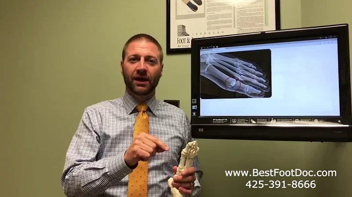 Cartiva Implant For Hallux Limitus