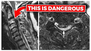 How to Read a Cervical MRI