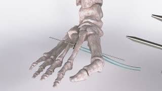 Famous CyclaPlex Surgical animation - Minimal invasive Non Osteotomy bunion correction surgical animation Wealth