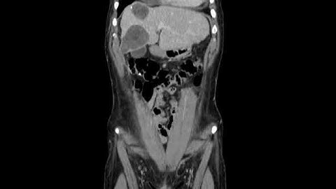 liver hydatid cyst CE 2, gharbi 3