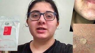 🤮WARNING GROSS CONTENT🤮 Cosrx Acne Pimple Master Patch Product Test and Mini Review