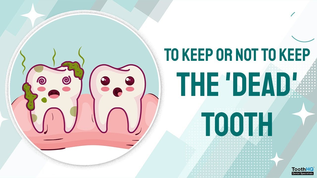 🚨 To Keep or Not to Keep: The 'Dead' Tooth Question Answered by Dr. Vadivel! 🦷