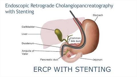ERCP with stenting