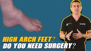 High Arch Feet? Do You Need Surgery? Youtube Shorts