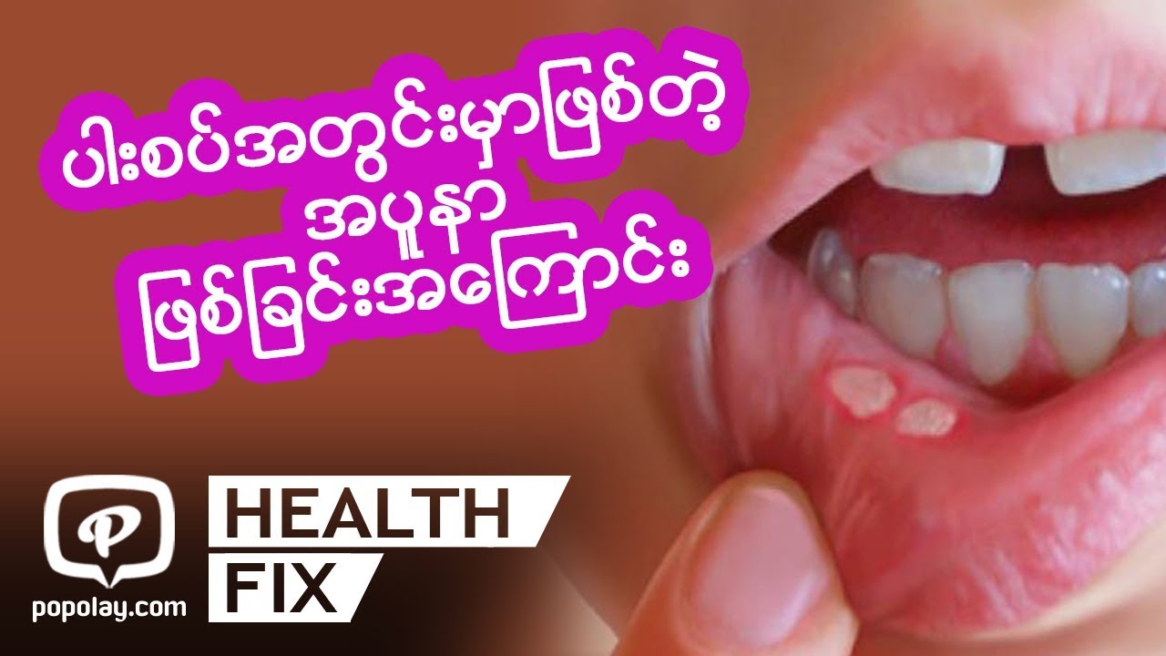 ပါးစပ္အတြင္းမွာျဖစ္တဲ့ အပူနာျဖစ္ျခင္းအေၾကာင္း