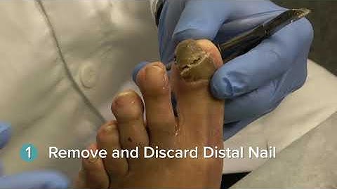 Nail Specimen Collection