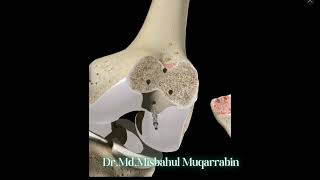 How Patellofemoral arthroplasty is done?