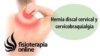 Hernia Discal Cervical Y Crvicobraquialgia