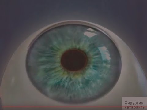 Видео: Как пережить операцию по удалению катаракты: 11 шагов (с иллюстрациями)