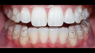 Attachments or buttons in clear Aligner