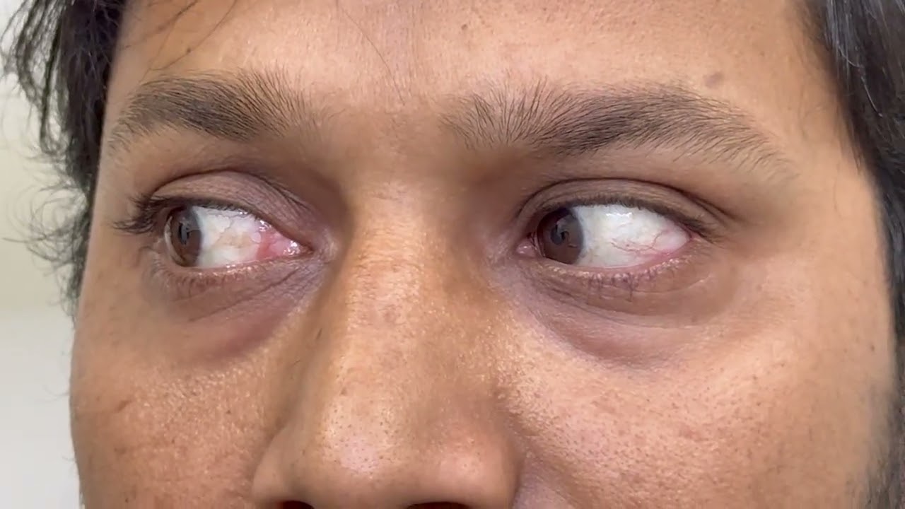 Acute Unilateral Vestibulopathy (Right)