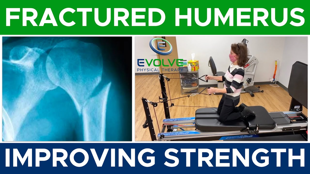 Fractured Humerus, Improving Strength