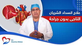 علاج انسداد الشريان التاجي بدون جراحة | دكتور اسامة عباس