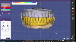 Lower full mouth FMR / Digital smile design workflow in Exocad - ALL ON TI LAB CHENNAI