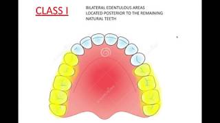 Kennedy's classification with applegate's rules (PROSTHODONTICS)