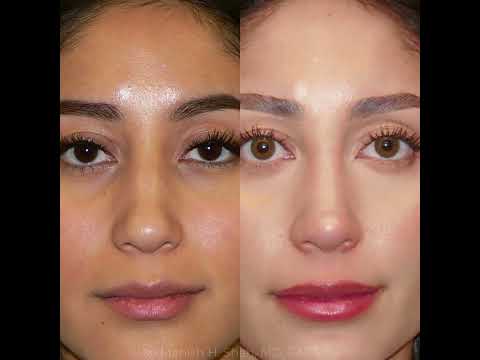 Video thumbnail: Ultrasonic Rhinoplasty Before and After #ultrasonicrhinoplasty #rhinoplasty #beforeandafter #nosejob · Dr. Manish H. Shah