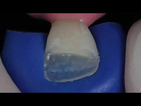 IPS Empress Direct - Highly esthetic class-IV restoration using IPS Empress Direct