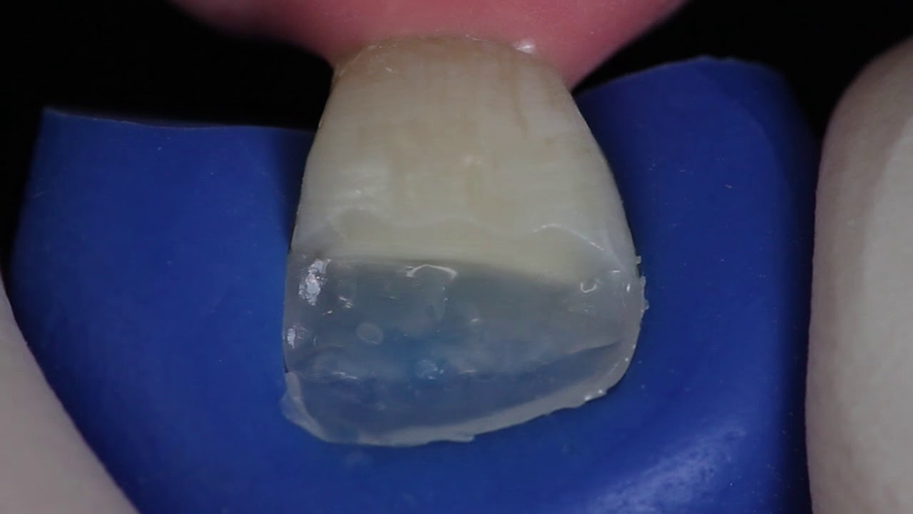 IPS Empress Direct Highly esthetic classIV restoration using IPS