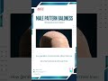 Male Pattern Baldness Explained | Timelapse 3D Medical Animation #shorts