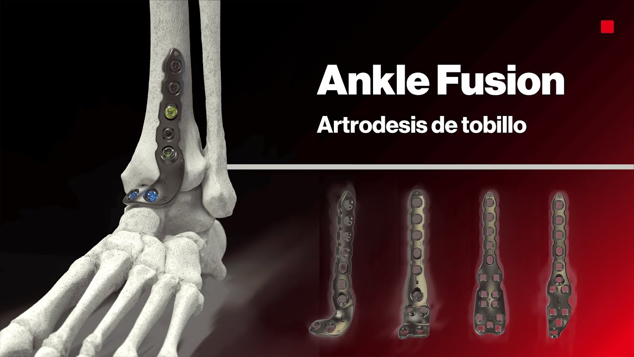 ANKLE FUSION® | Artrodesis de tobillo