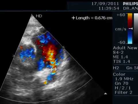 Join told Ductus arteriosus patent adult not absolutely Recommend you Ductus arteriosus patent adult something also