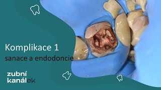 Komplikace v zubařině - sanace a endodoncie