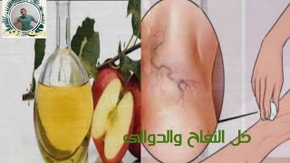 علاج دوالى الساقين!طرق طبيعيه لمحاربه الدوالى العنكبوتيه .....الشعيرات الدمويه