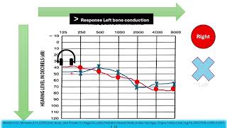 Hearing Loss in Pediatrics and Audiograms