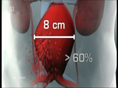 Video: Bauchaortenaneurysma - Symptome, Behandlung, Operation, Ruptur