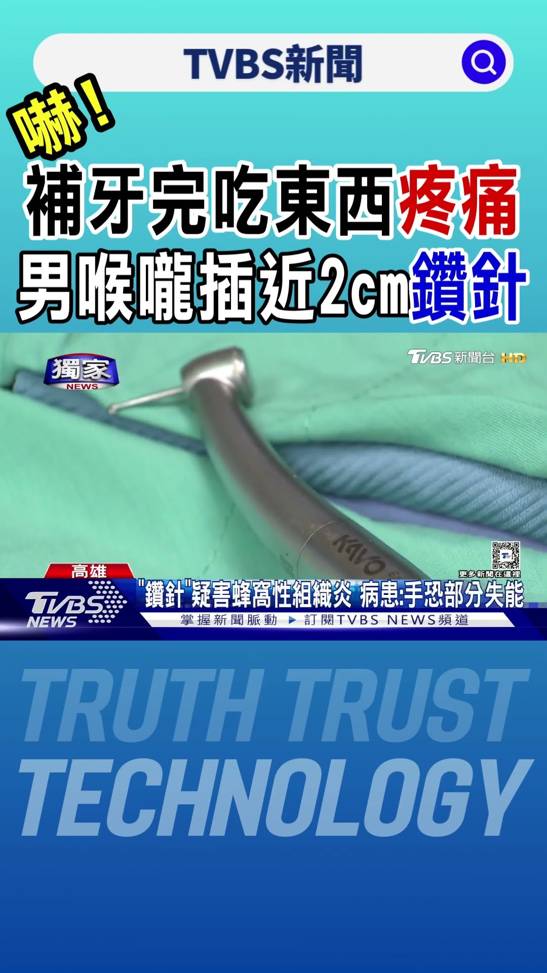 #獨家 嚇! 補牙完吃東西「疼痛」 男喉嚨插近2cm「鑽針」｜TVBS新聞 @TVBSNEWS01