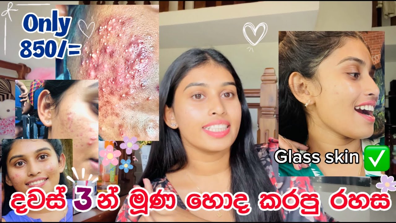 දවස් 3යි🫨| රු.850🌿| Magic product🥺🌷| Glass skin look එකක් ආවා💕🌸 #foryou #glassskin #pimple #tips