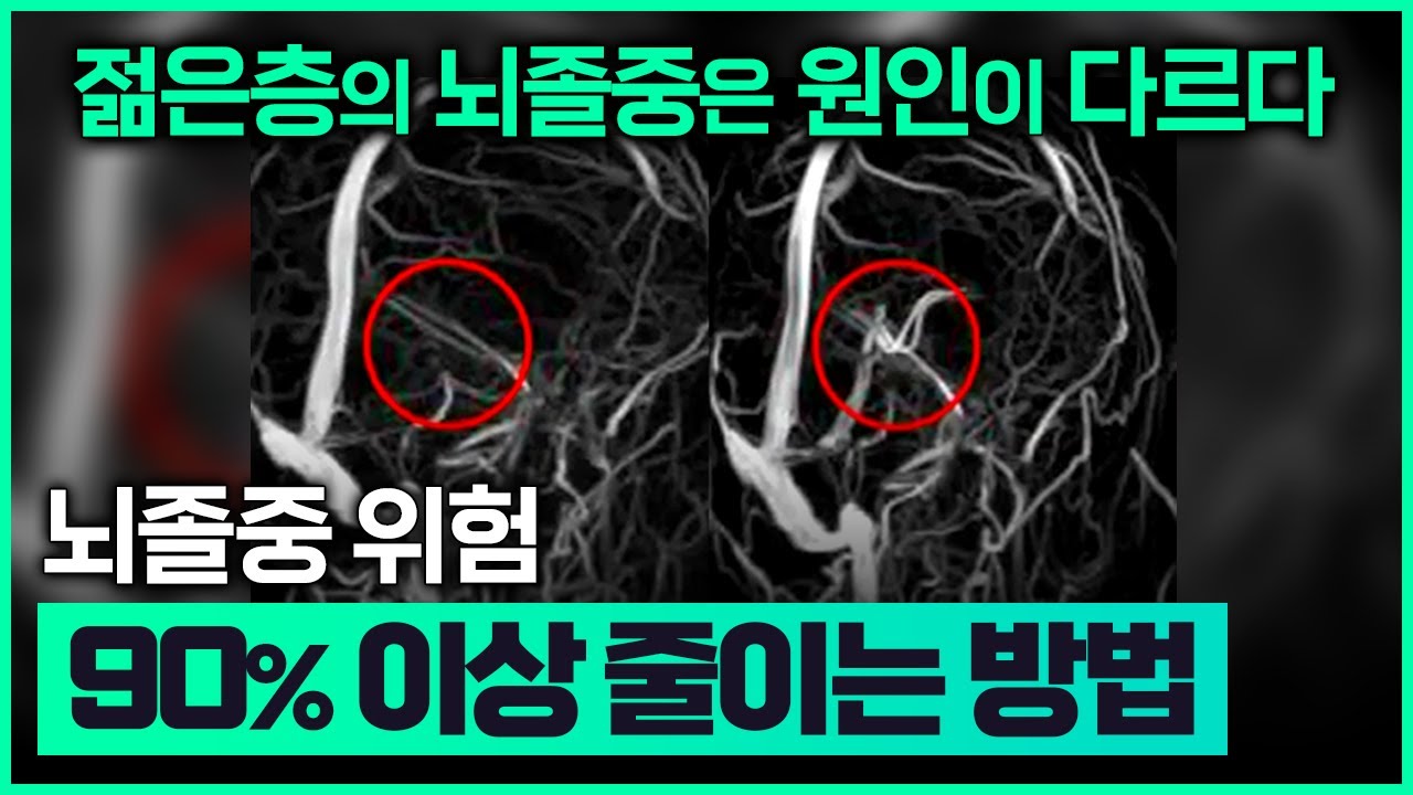 젊은층의 뇌졸중은 원인이 다르다/탄산음료가 뇌졸중 위험률을 증가시킨다/미세먼지도 뇌졸중의 원인이 된다/뇌졸중 위험 90%이상 줄이는 방법/ 부산MBC  190121 방송