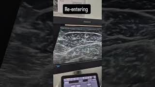 Us Guided Dry Needling And Local Twitch