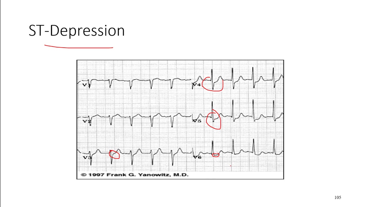 ECG 10 Ischemic Changes YouTube ECG 10 Ischemic Changes YouTube